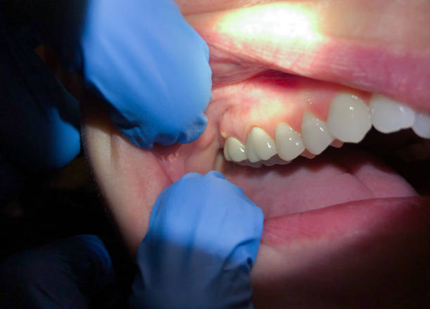 Best Emergency Dental Care for Broken or Chipped Teeth in Landing, NJ